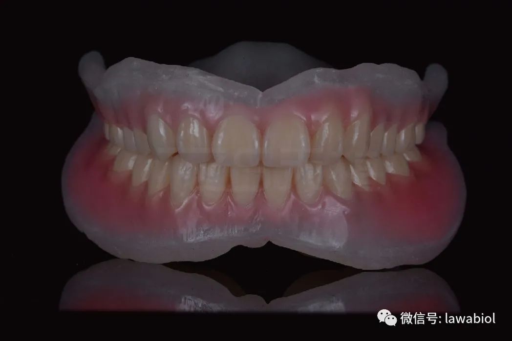 病例分享天植全口无牙颌修复一例